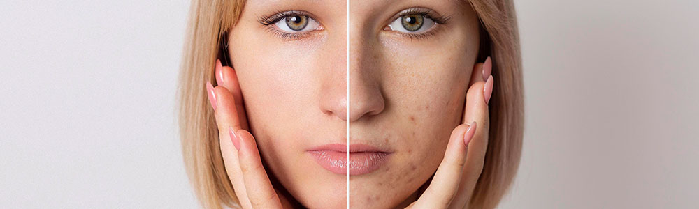 CCL_Zinc-Oxide-Comedogenic-Rating-A-Friend-or-Foe-for-Your-Acne