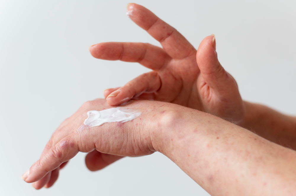 Should We Consider Zinc Oxide for Scars Treatment? Citra CakraLogam